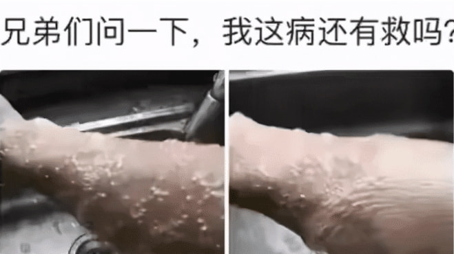 “一沾水就犯病!我这是怎么了?”不要可以卸掉 “一沾水就犯病!我这是怎么了?”不要可以卸掉