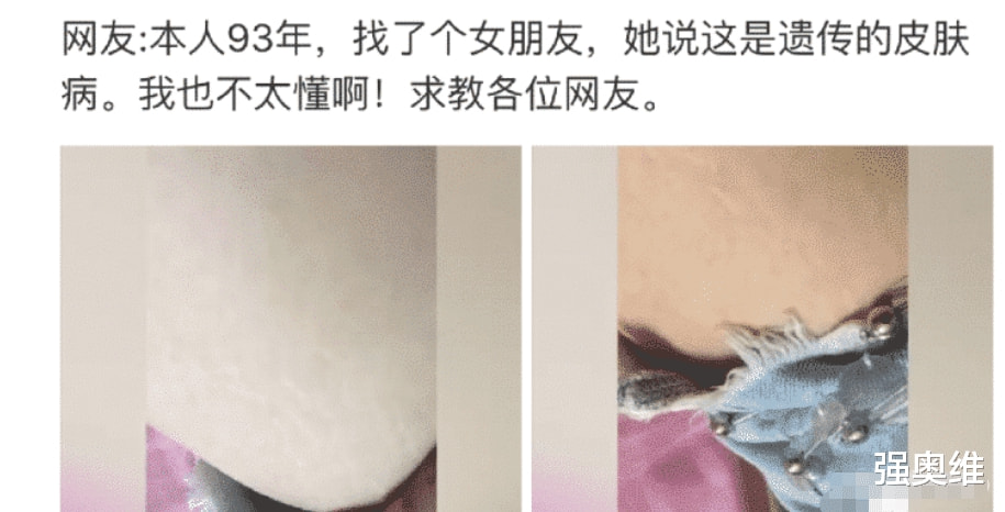 “找了个日本老婆,她说这是天生的皮肤病!” “找了个日本老婆,她说这是天生的皮肤病!”
