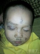 一个中招的小孩子。