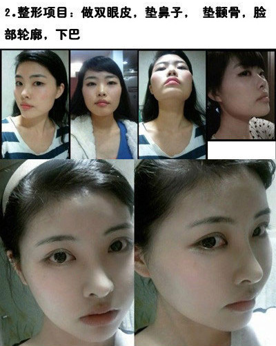 整容整出来的美女胚子。