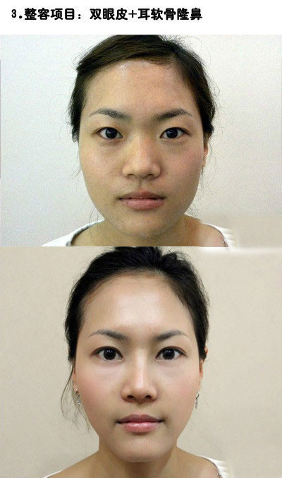 整容整出来的美女胚子。