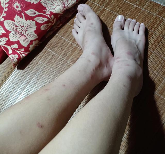 我这是被什么东西咬的? 我这是被什么东西咬的?
