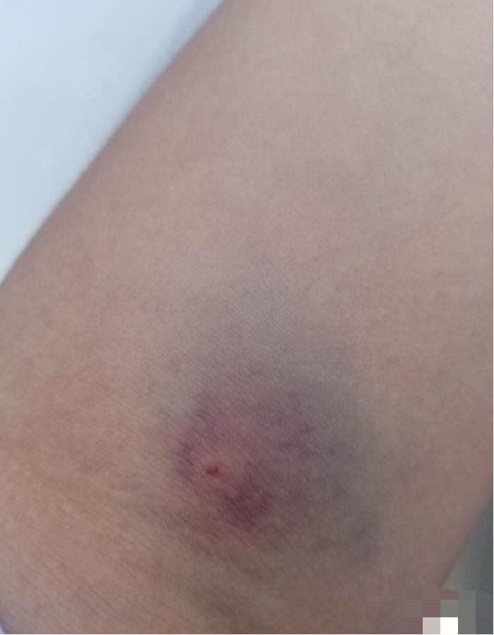 “献血之后,手腕就变成这样了!有人知道是啥情况吗?太吓人了!” “献血之后,手腕就变成这样了!有人知道是啥情况吗?太吓人了!”
