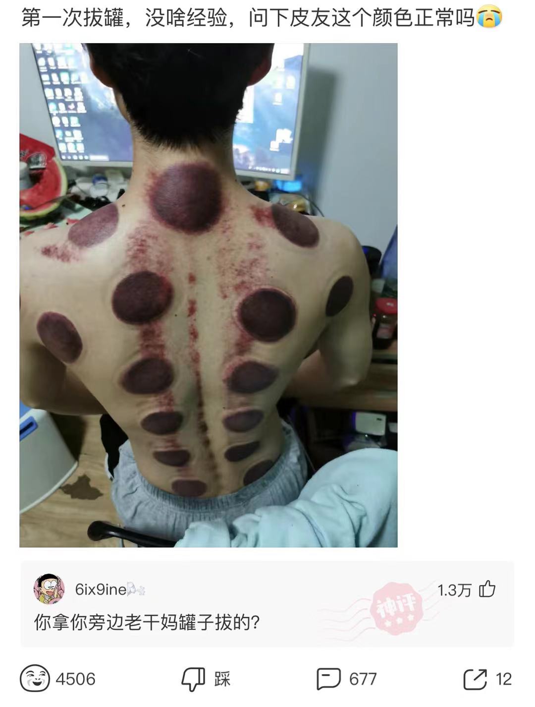 神回复:神回复:第一次拔罐,没啥经验,问一下这个颜色正常吗? 神回复:神回复:第一次拔罐,没啥经验,问一下这个颜色正常吗?
